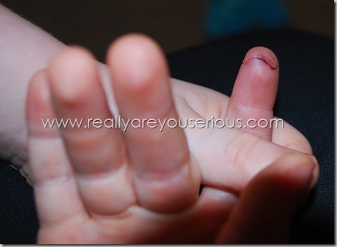 sliced finger